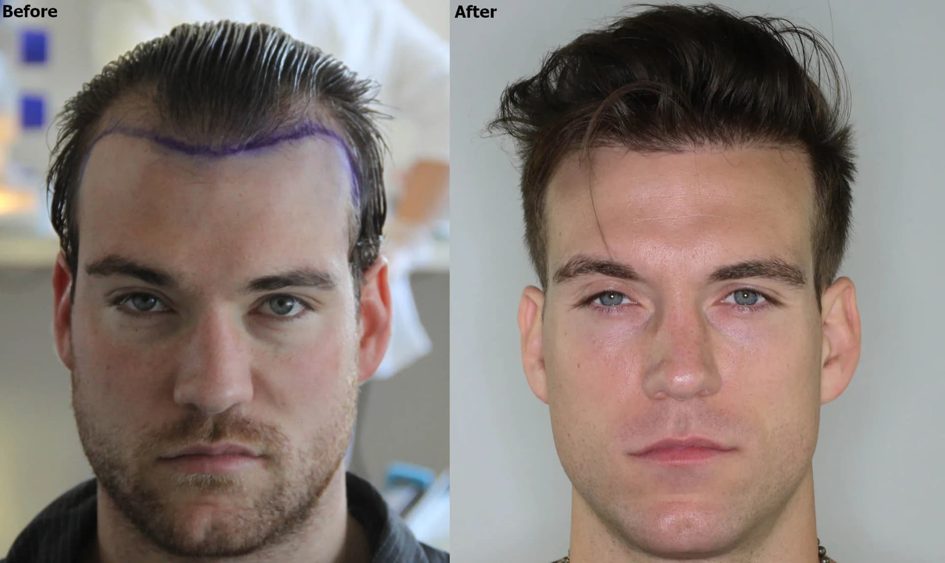 Hair Transplant – Permanent Solution for Hair Loss