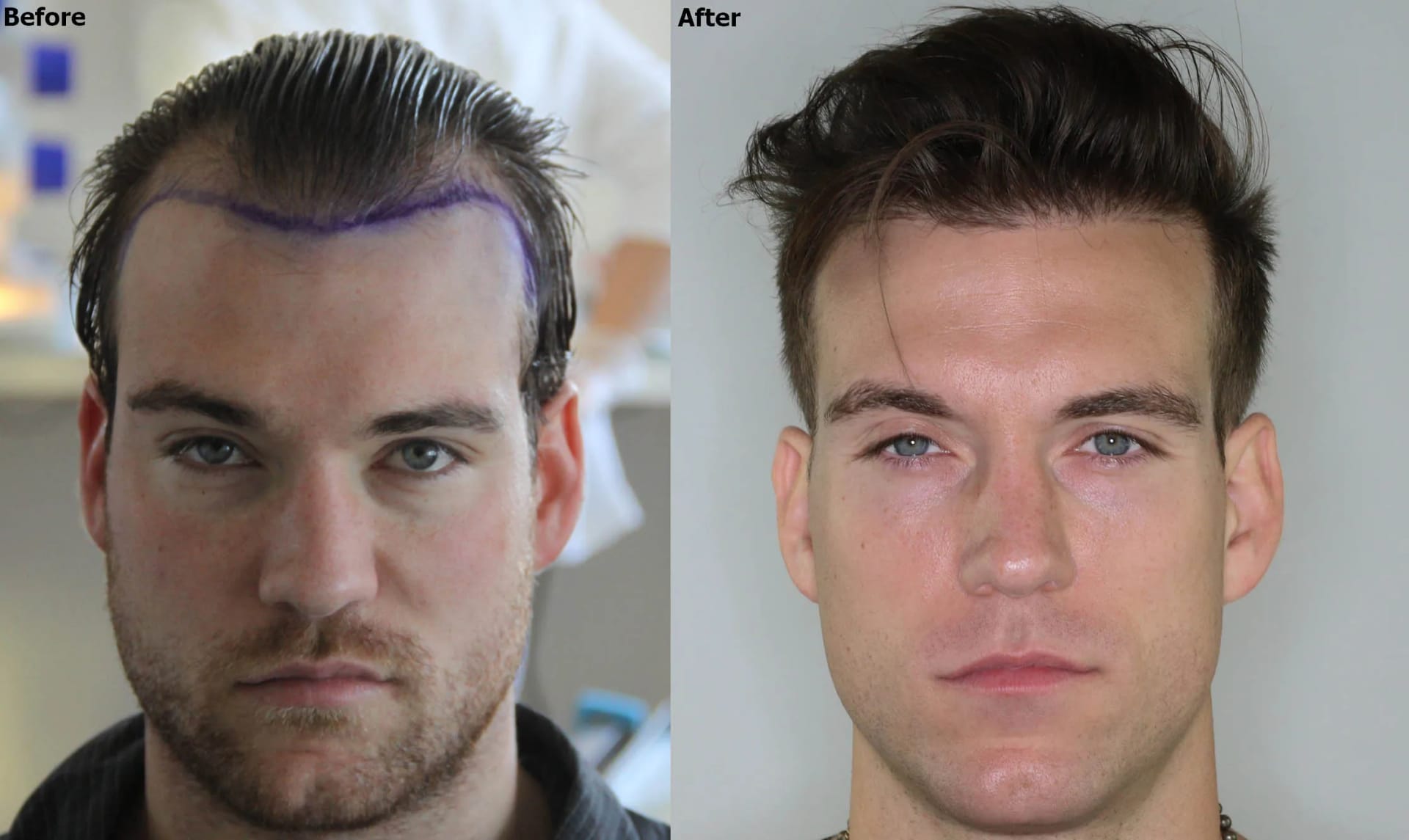 Hair Transplant – Permanent Solution for Hair Loss