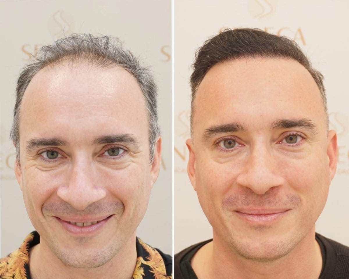 Hair Transplant UK – Top Technology Meets Skilled Hands
